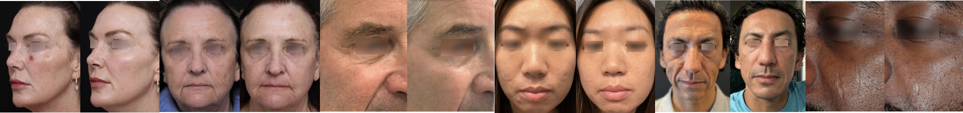 Diverse Hauttypen Fitzpatrick I–VI