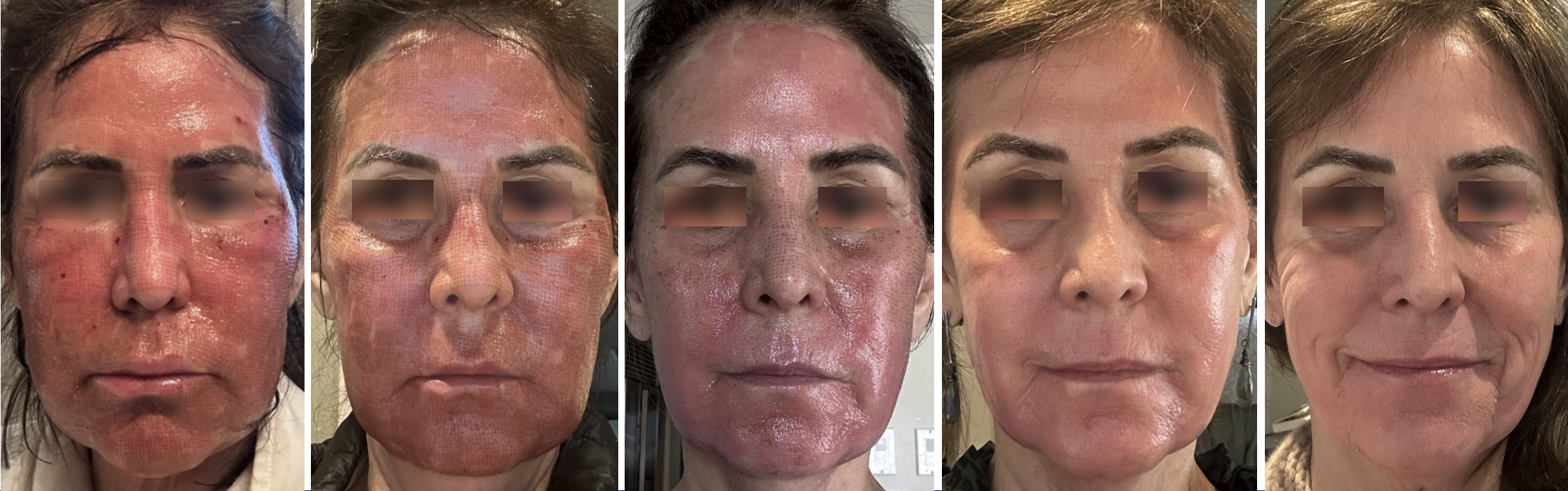 Heilungsverlauf Patientin 1